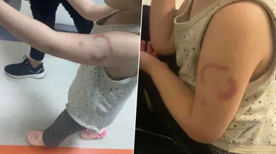 Kreşte üç yaşındaki çocuğu ısıran bakıcı tutuklandı