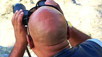 Yeni kellik ilacı: Yüzde 539 oranında saç artışı